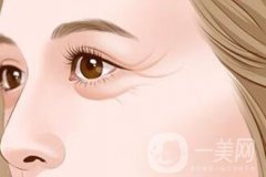 去除魚尾紋的方法有哪些？哪種方法比較好？