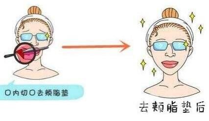 去頰脂墊價格貴嗎？大概價位是多少？