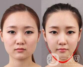 去頰脂墊有副作用嗎？術(shù)后如何護(hù)理可以減小副作用？