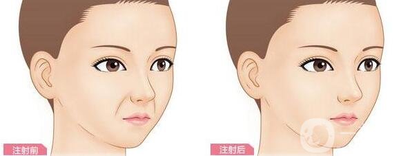 玻尿酸豐鼻唇溝能維持多長時間?