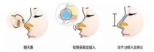 朝天鼻整形價(jià)格貴嗎?大概要多少錢(qián)?