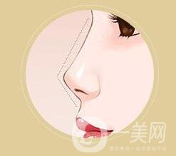 朝天鼻整形價(jià)格貴嗎?大概要多少錢(qián)?