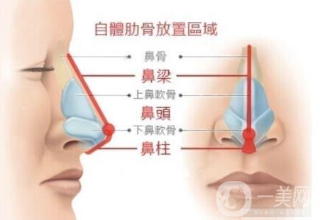 韓式肋骨隆鼻手術(shù)多少錢？*果怎樣？