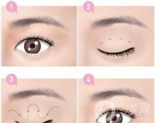 *需要拆線嗎？多長時間可以碰水？