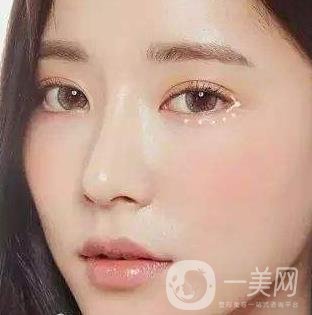 *需要拆線嗎？多長時間可以碰水？