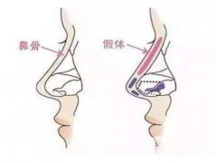 假體隆鼻整型術術前準備有哪些？