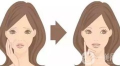 頸部除皺提升術(shù)果明X嗎?能保持多少年?