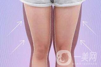 大腿環(huán)形吸脂多久恢復(fù)？會(huì)有疤嗎？