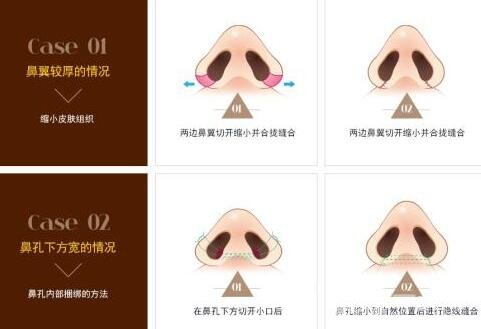 鼻頭縮小手術(shù)價(jià)格是多少?價(jià)格受什么因素影響