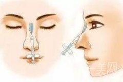 注射隆鼻后注意什么才能恢復(fù)得更快?