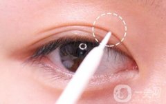 做雙眼皮手術(shù)過(guò)程是怎樣的?需要多久?