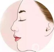 如何讓鼻梁變高？可以注射玻尿酸嗎？