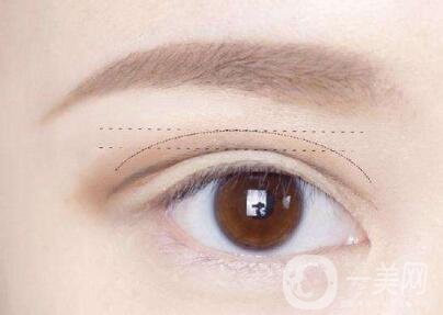三點(diǎn)定位雙眼皮手術(shù)后應(yīng)該注意些什么？