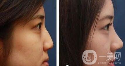 隆鼻手術