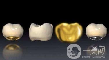 貴金屬烤瓷牙有哪些種類？