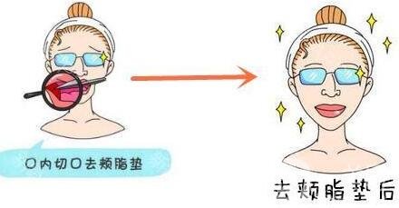去頰脂墊價(jià)格貴不貴?收費(fèi)情況說明