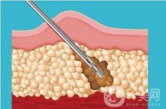 聚能吸脂的優(yōu)缺點(diǎn)盤點(diǎn)