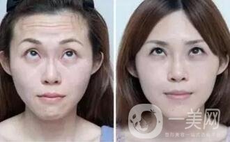 清除抬頭紋