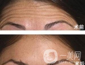 清除抬頭紋