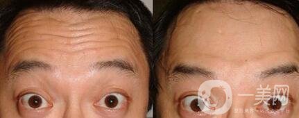 清除抬頭紋