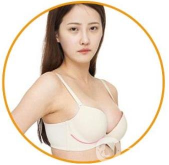 娜綺麗隆胸多久變軟？怎么加速變軟？