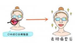 去頰脂墊果怎么樣？明X嗎？