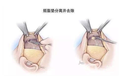 去頰脂墊*果怎么樣？*嗎？