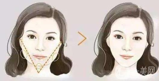 去頰脂墊*果怎么樣？*嗎？