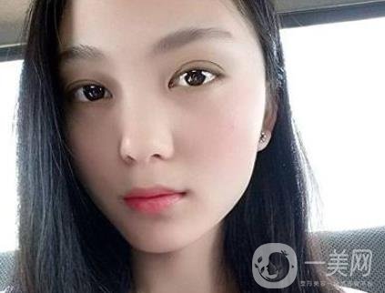 吸雕雙眼皮手術(shù)是什么？是埋線嗎？