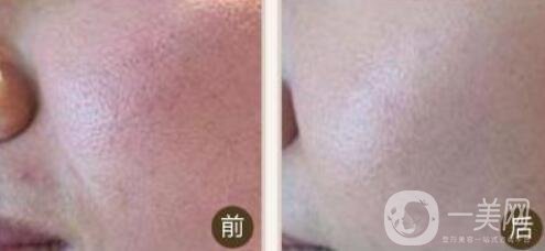 光子嫩膚
