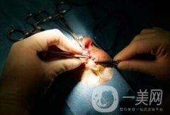 做唇裂手術(shù)多少錢?要做幾次?