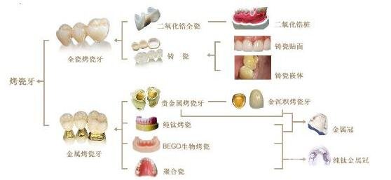 烤瓷牙的種類有哪些?哪種比較好?