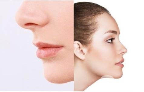 怎樣讓鼻子變高？隆鼻可以讓鼻子變高嗎？