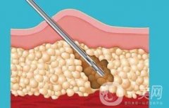 什么是環(huán)形吸脂減肥？優(yōu)點有哪些？