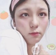 六盤(pán)水友好整形醫(yī)院價(jià)格表及雙眼皮術(shù)后果分享