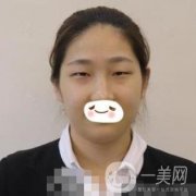 濟南旭美整形醫(yī)院靠譜嗎?附雙眼皮案例和全新價格表