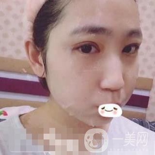 濟(jì)南旭美整形醫(yī)院靠譜嗎?附雙眼皮案例和全新價格表