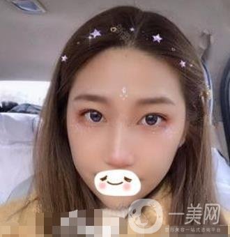濟(jì)南旭美整形醫(yī)院靠譜嗎?附雙眼皮案例和全新價格表