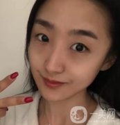 吉大一院整形外科價格表明細(xì)公布，隆鼻紀(jì)實案例分享