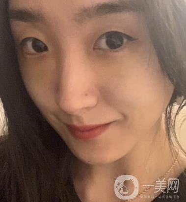 吉大一院整形外科價格表明細公布，隆鼻紀實案例分享