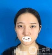 廣州禾麗醫(yī)院做雙眼皮怎么樣?看果圖和價格表