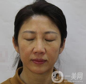安徽醫(yī)科大學(xué)第(一)附屬醫(yī)院整形外科價(jià)格表，附去眼袋案例