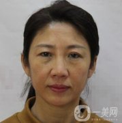 安徽醫(yī)科大學(xué)第(一)附屬醫(yī)院整形外科價格表，附去眼袋案例