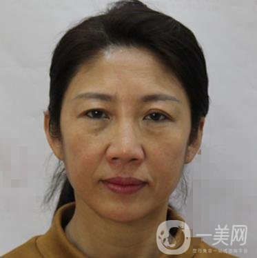 安徽醫(yī)科大學(xué)第(一)附屬醫(yī)院整形外科價(jià)格表，附去眼袋案例