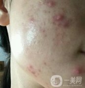 江門夢(mèng)想整形醫(yī)院去痘印需要多少錢?價(jià)格表和真人整形日記一覽