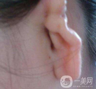 2020年石家莊第(一)醫(yī)院整形美容科價格表和耳朵畸形修復(fù)案例一覽