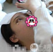 溫嶺芘麗芙整形醫(yī)院2020年價格表更新_雙眼皮整形果實拍