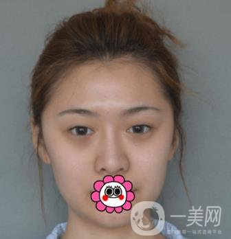 延吉金光善整形美容醫(yī)院價格表收費明細_雙眼皮手術真人體驗分享
