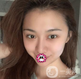 延吉金光善整形美容醫(yī)院價格表收費明細_雙眼皮手術真人體驗分享