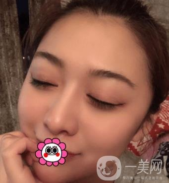 延吉金光善整形美容醫(yī)院價格表收費明細_雙眼皮手術真人體驗分享